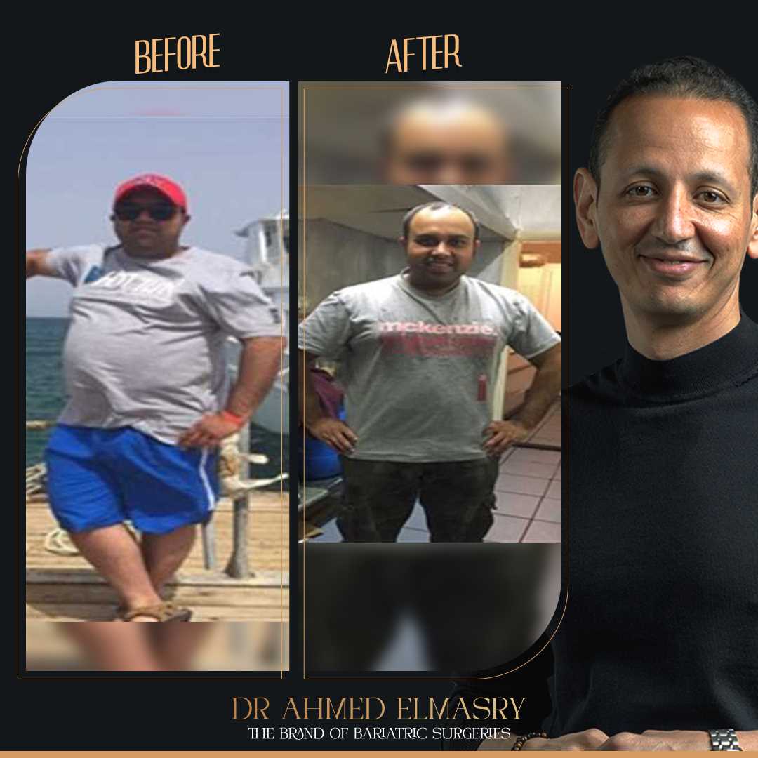 Gastric Sleeve..And Khaled's success story!